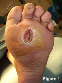 Figure 1 - Diabetic Foot Ulcer