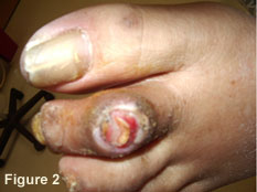 Figure 2 - Diabetic Foot Ulcer